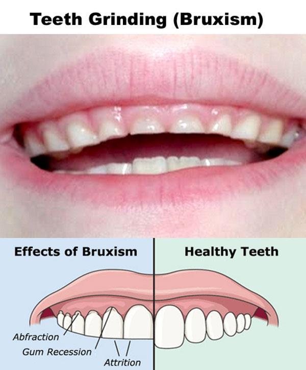 Are you gritting your teeth during your sleep?