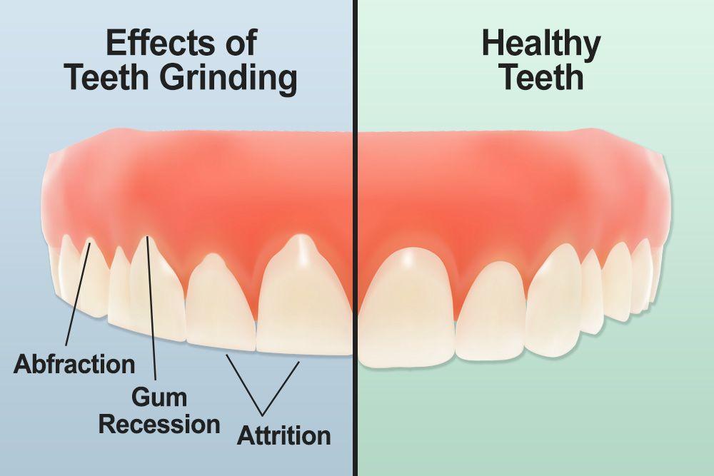 Teeth Grinding - Boston, MA - Dr. James M. Stein