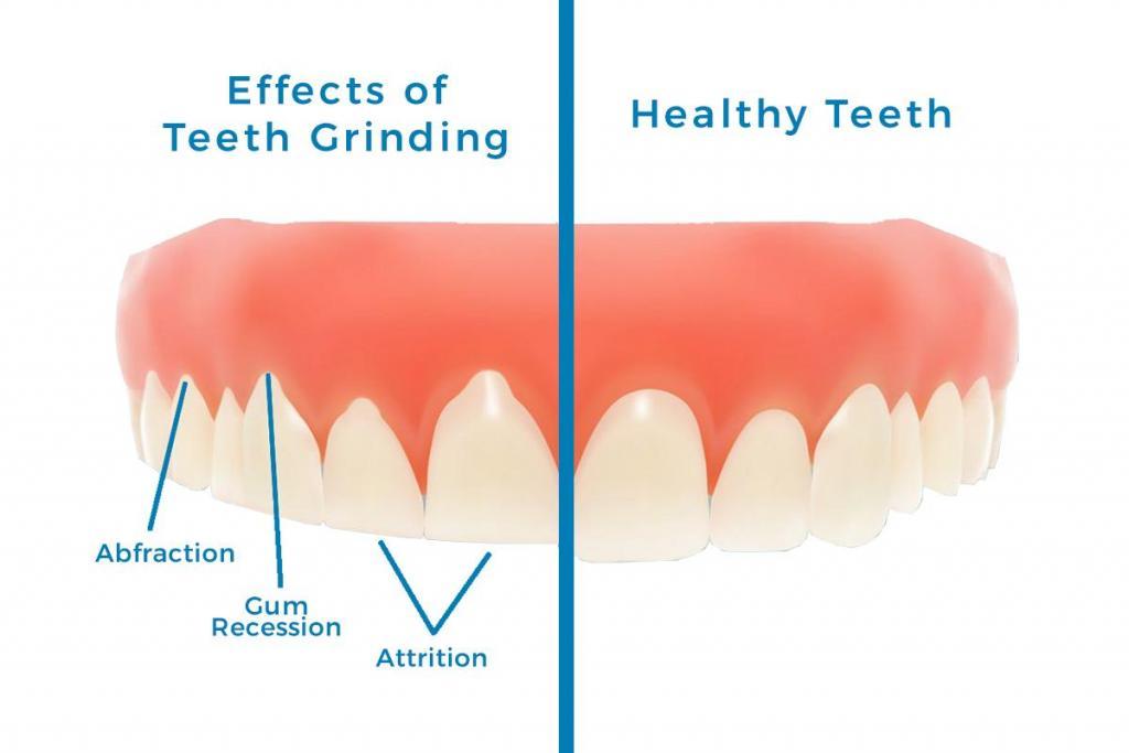 Grinding & Clenching - Complete Dental Wynnum