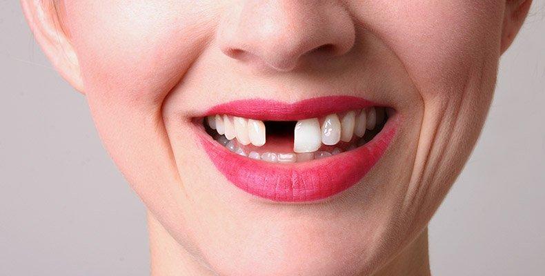 Losing Teeth in a Dream? - Christchurch Dental