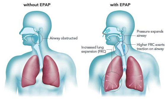 Expiratory Positive Airway Pressure Snoring Devices – Snoring Devices Australia