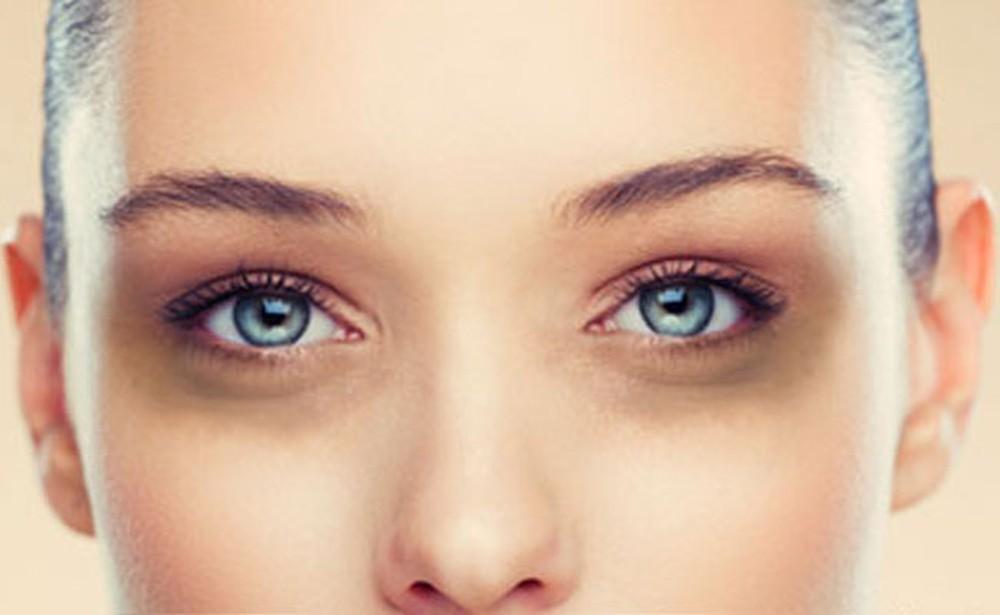 Periorlital Melanosis (Dark Circles) Treatment in Ludhiana | Dark Circle Removal Cost in Ludhiana